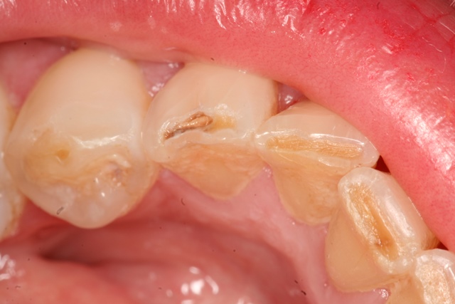 tooth decay, bonding, white filling, 
