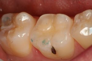 decay, tooth wear, bonding,