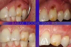 Single tooth gingival graft for root coverage