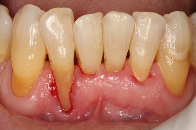 Severe localized gingival recession.