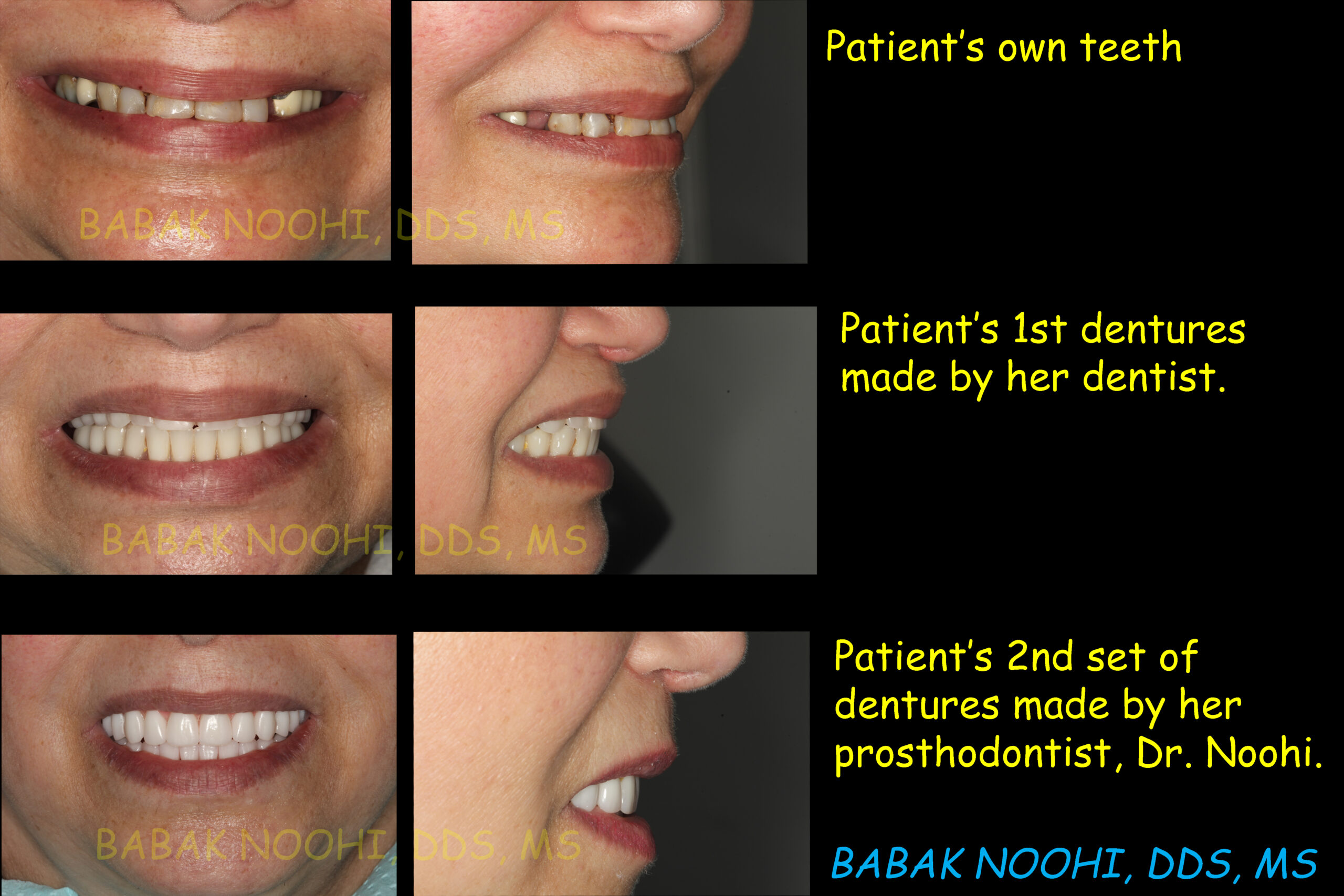 Comparing two sets of complete dentures. One is made by a General Dentist and the second set is made by a prosthodontist for the same patient.