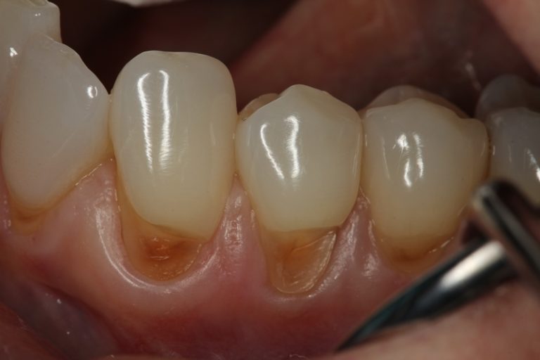 Can tooth brushing wear off my teeth? Capitol Hill Dentistry