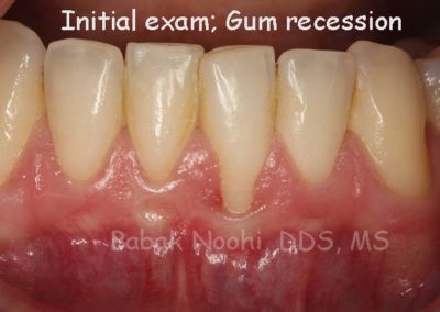 Initial exam: gum recession around a single tooth.