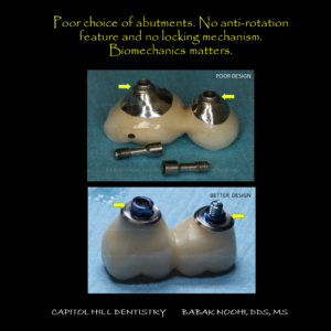 Comparing two different splinted implant crown design. One was a failed design by a dental technician, the lower image is a similar case fabricated by a prosthodontist to minimize the risks.