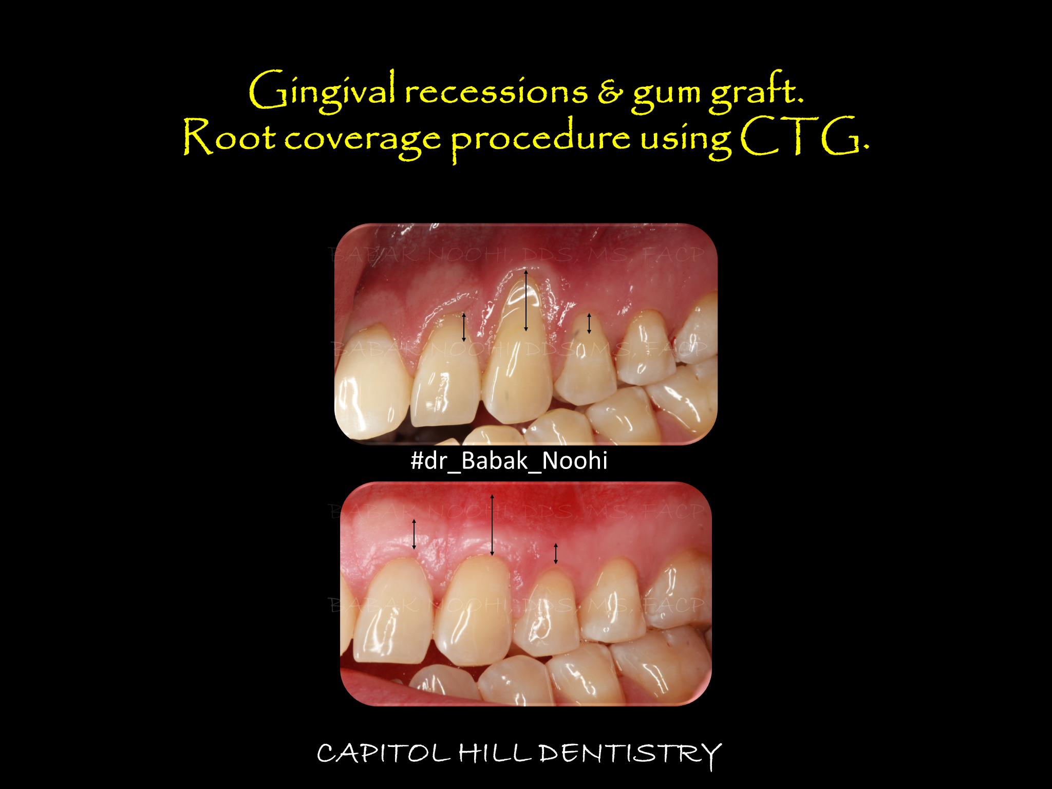 Gingival Graft for Root Coverage of Multiple teeth.
